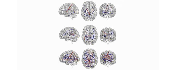 Проривний штучний інтелект передбачає, у яких дітей розвинеться аутизм