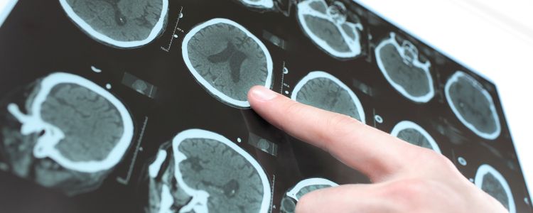 Новий генетичний тест завбачить якщо і коли у вас розвинеться хвороба Альцгеймера