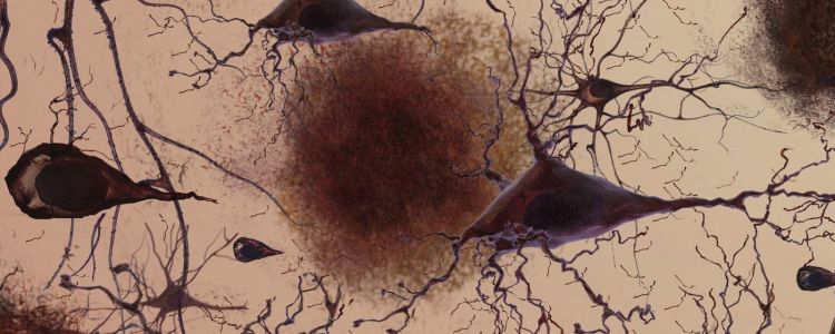 Новий препарат проти хвороби Альцгеймера - представляємо NTRX-07