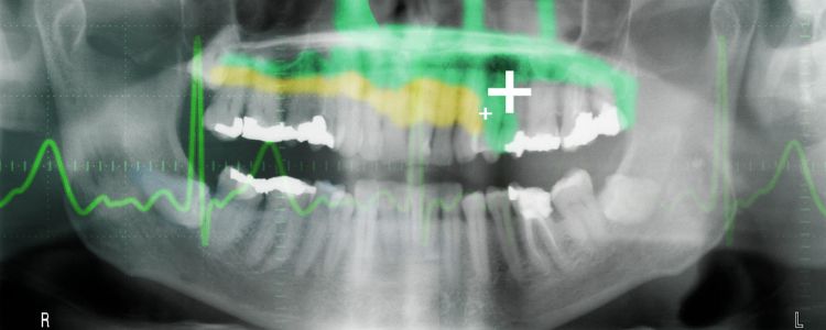 Пломби із стовбуровими клітинами наділяють зуби можливістю самозцілення