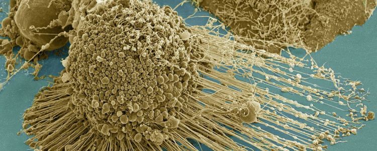 Вчені виявили спосіб «спалити ноги» раку