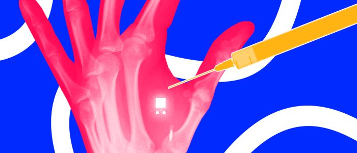 Останній тренд Швеції: введення мікрочипів під шкіру