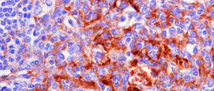 У міру старіння населення в Японії поширюється рідкісне захворювання мозку