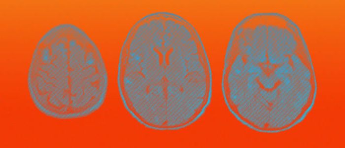 Коронавірусні хворі страждають на інсульти та порушення мозку