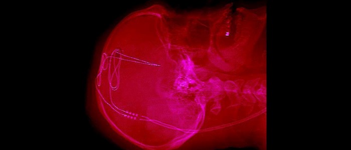 Лікарі використовують імплантати у людському мозку для боротьби з наркоманією