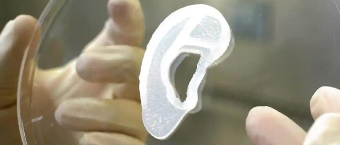 Лікарі пересадили вухо, надруковане на 3D-принтері із власних клітин пацієнта
