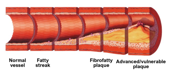 Дослідники виявили двадцять генетичних варіацій, які збільшують ризик атеросклерозу