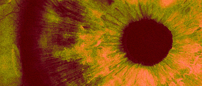 Генна терапія, введена в очне яблуко, відновлює зір сліпого пацієнта