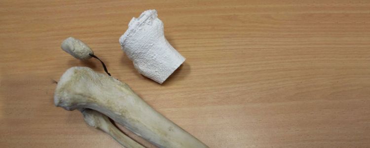 Людина отримала першу в світі 3Д-друковану заміну великогомілкової кістки