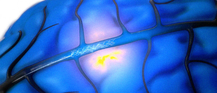 Людина зі склерозом використовує мозковий імплантат, який переводить думки до тексту