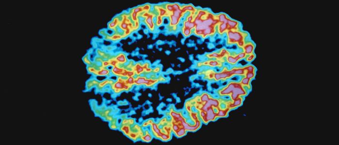 Приз тому, хто доведе, що хворобу Альцгеймера викликають мікроби