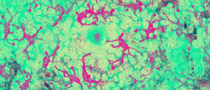 Вчені виявили імунну клітину, яка вбиває більшість ракових захворювань