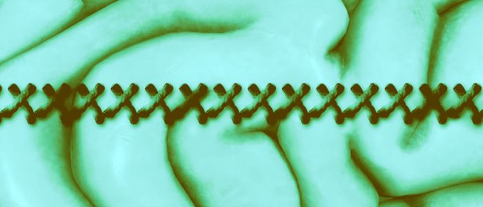 Вчені винайшли «швейну машинку» для імплантації електродів у мозок