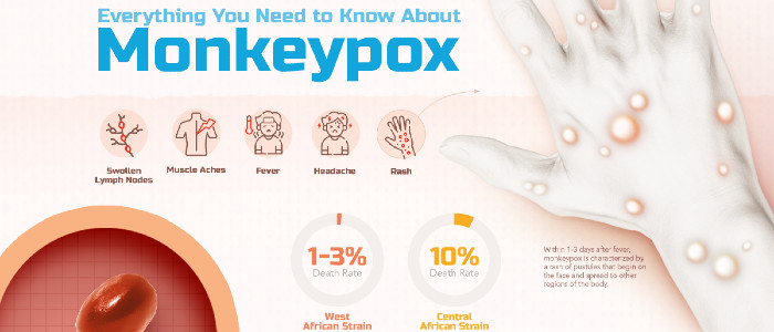Вчені стурбовані міжнародним спалахом мавпячої віспи