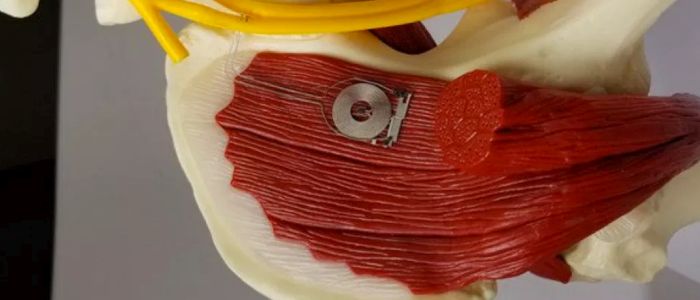 Цей бездротовий імплантат лікує пошкоджені нерви, а потім саморуйнується