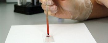 Новий тест може виявити рак за роки до появи симптомів