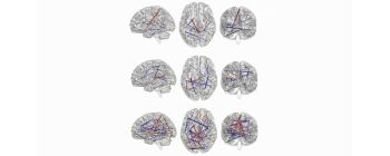 Проривний штучний інтелект передбачає, у яких дітей розвинеться аутизм