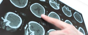 Новий генетичний тест завбачить якщо і коли у вас розвинеться хвороба Альцгеймера