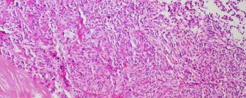 УПМ має швидкий спосіб лікування раку, перший в своєму роді