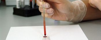 Новий тест дозволяє більш просте і раннє виявлення хвороби Альцгеймера