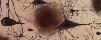 Новий препарат проти хвороби Альцгеймера - представляємо NTRX-07