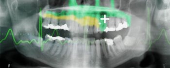 Пломби із стовбуровими клітинами наділяють зуби можливістю самозцілення