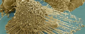 Вчені виявили спосіб «спалити ноги» раку