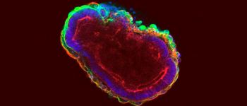 Трансплантація стовбурових клітин дозволила інваліду знову танцювати