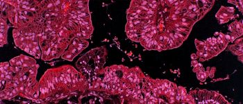 Успіх Австралії показує, що ми теж можемо усунути рак шийки матки