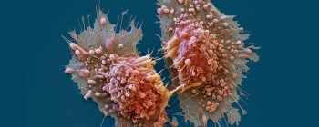 ШІ рятує життя жінки шляхом виявлення захворювання, коли інші методи не спрацювали