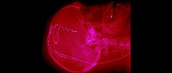 Лікарі використовують імплантати у людському мозку для боротьби з наркоманією