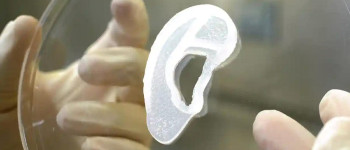 Лікарі пересадили вухо, надруковане на 3D-принтері із власних клітин пацієнта