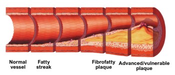 Дослідники виявили двадцять генетичних варіацій, які збільшують ризик атеросклерозу