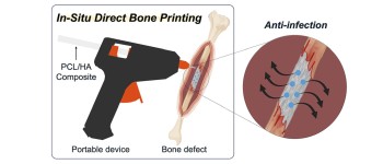 «Клейовий пістолет» друкує кісткові трансплантати прямо на переломах під час операції