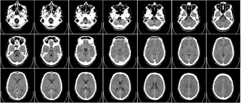 Лише одне сканування мозку тепер може діагностувати хворобу Альцгеймера