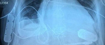 Нове біонічне серце заряджається без дротів всередині грудей пацієнта