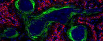 Нова недорога терапія раку може вбити пухлини за допомогою етанолу