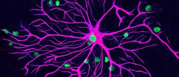 Нове дослідження може зупинити розсіяний склероз