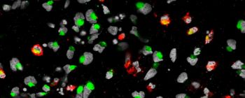 Нове дослідження показує, що вірус Зіка вбиває стволові клітини раку мозку