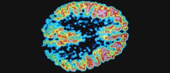 Приз тому, хто доведе, що хворобу Альцгеймера викликають мікроби