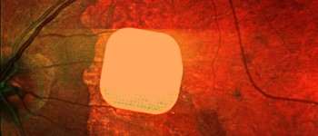 Експерти вітають «чудовий» успіх електронного імплантату у відновленні зору