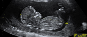 Дослідники виявили мікропластик усередині новонароджених