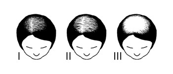 Вчені вирощують людське волосся на мишах, щоб пересадити його лисим людям