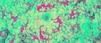 Вчені виявили імунну клітину, яка вбиває більшість ракових захворювань