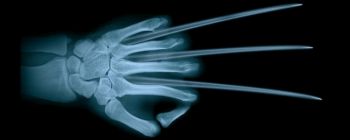 Вчені виявили новий спосіб регенерації людських кісток і тканини