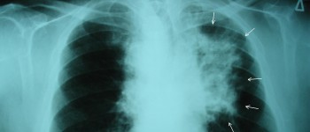 Вчені заінтриговані ліками, які вдвічі знижують смертність від раку легень