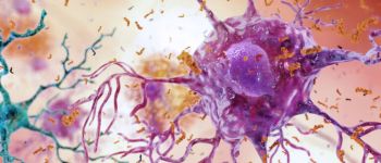 Вчені виявили процеси, що передують хворобі Альцгеймера