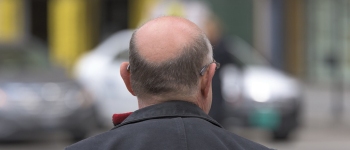 Вчені пов'язують облисіння у чоловіків із надзвичайно популярними напоями