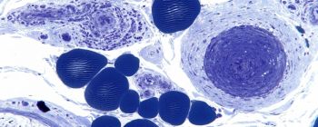 Клітини шкіри можуть бути будівельними блоками в боротьбі з раком та іншими захворюваннями