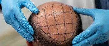 Тайванська сироватка відновлює волосся у лисих мишей за 20 днів